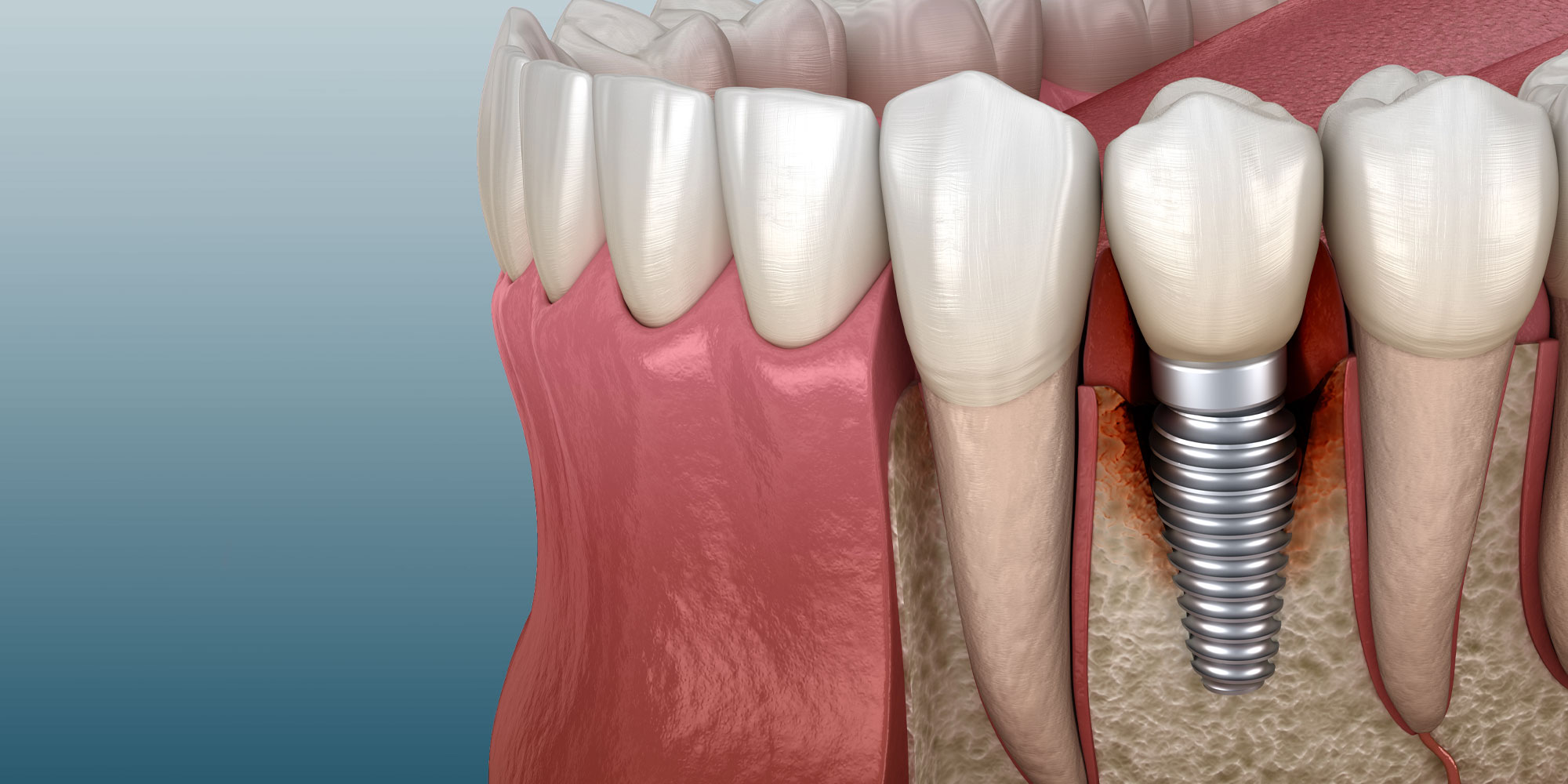 Illustration of peri-implantitis inflammation around an implant