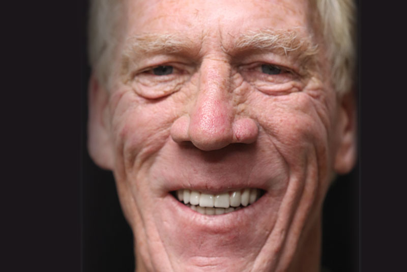 Smile after dental implant treatment