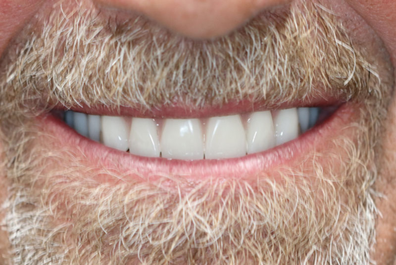 Smile after dental implant treatment
