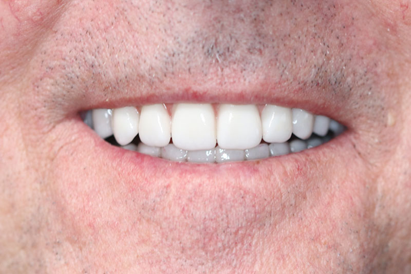 Smile after dental implant treatment