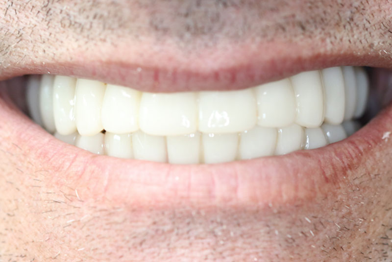 Smile after dental implant treatment