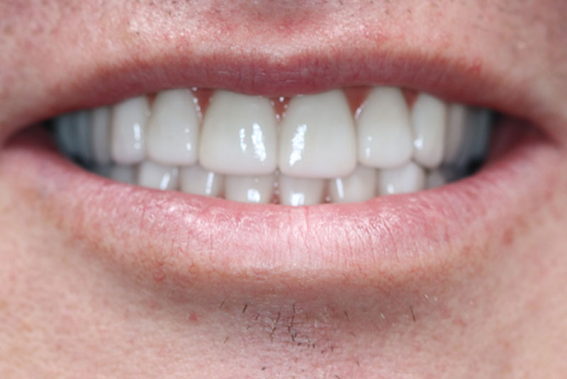 Smile after dental implant treatment