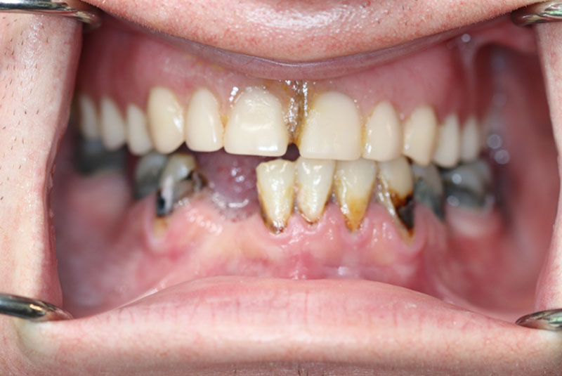 Smile before dental implant treatment