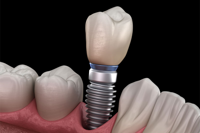 Single Implant