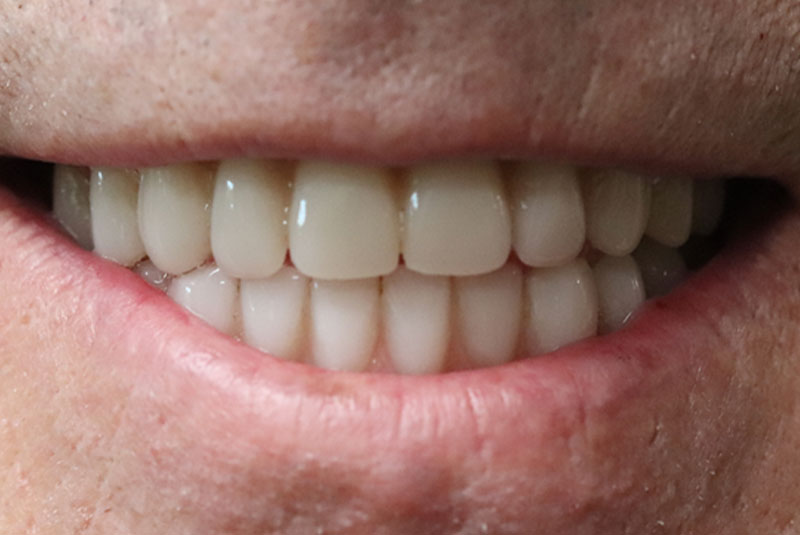 Smile after dental implant treatment