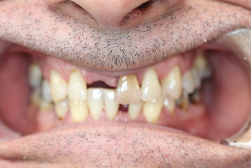Smile before dental implant treatment