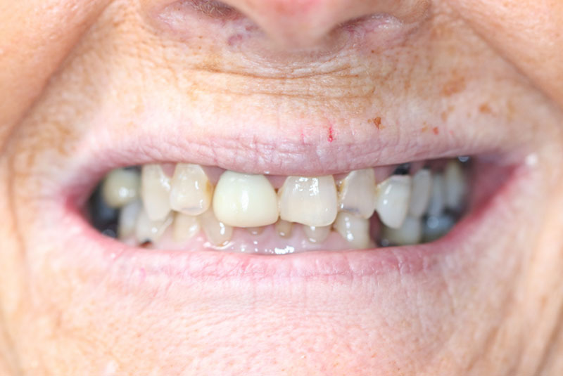 Smile before dental implant treatment