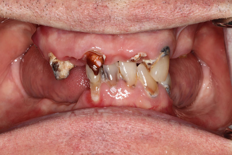 Smile before dental implant treatment