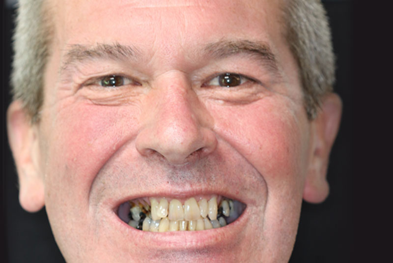 Smile before dental implant treatment