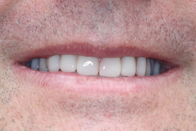 Smile after dental implant treatment