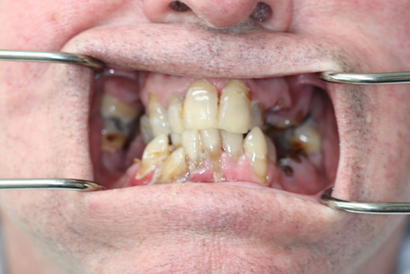 Smile before dental implant treatment