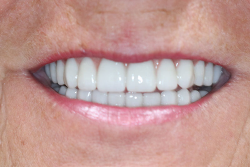 Smile after dental implant treatment
