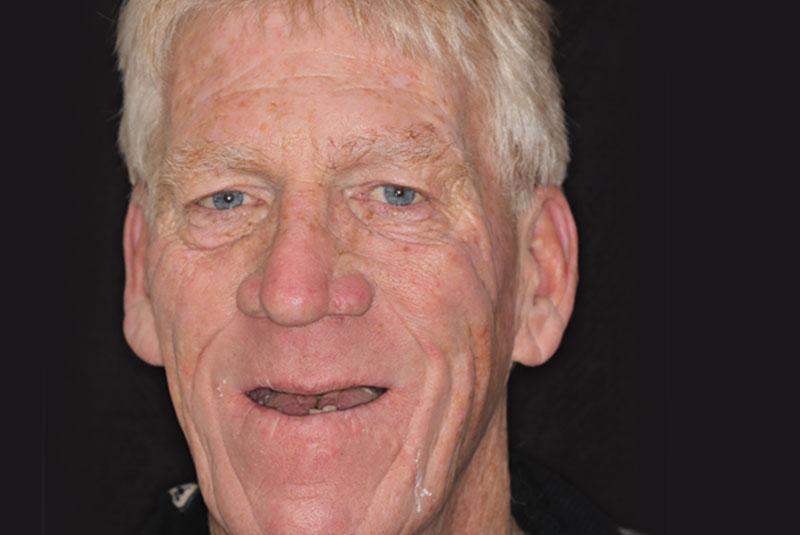 Smile before dental implant treatment