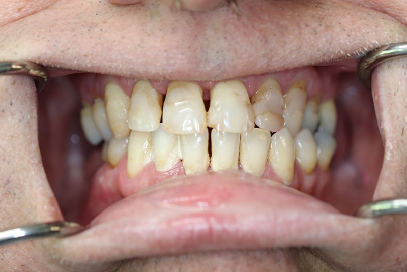 Smile before dental implant treatment