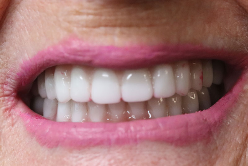 Smile after dental implant treatment
