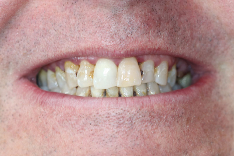 Smile before dental implant treatment