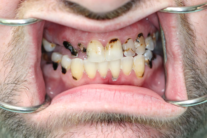 Smile before dental implant treatment
