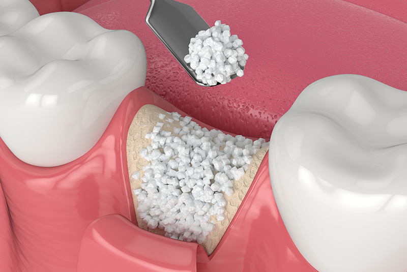 Bone grafting procedure restoring jaw volume