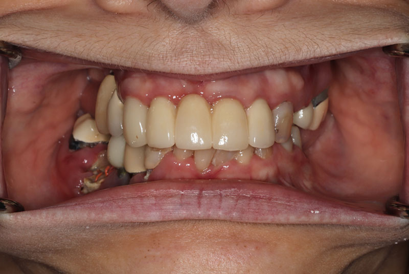 Smile before dental implant treatment