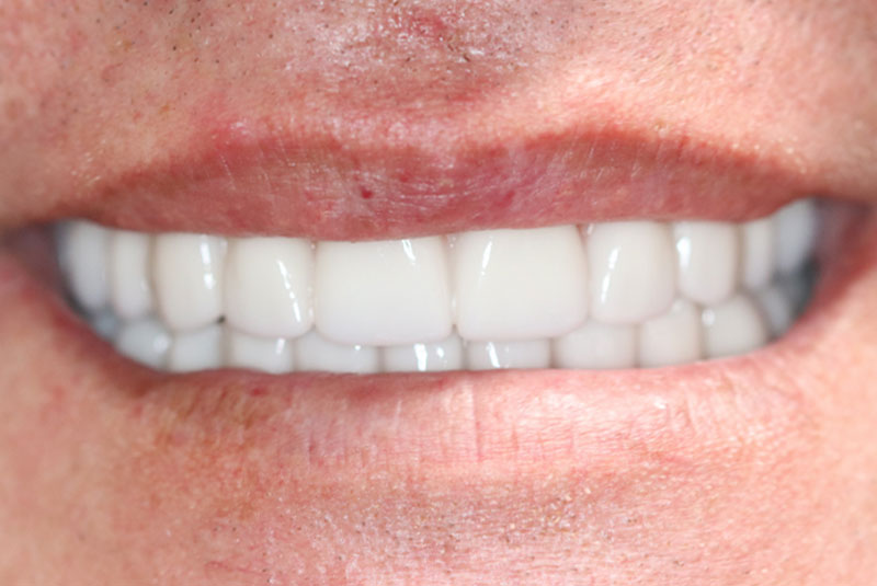 Smile after dental implant treatment