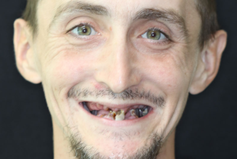 Smile before dental implant treatment