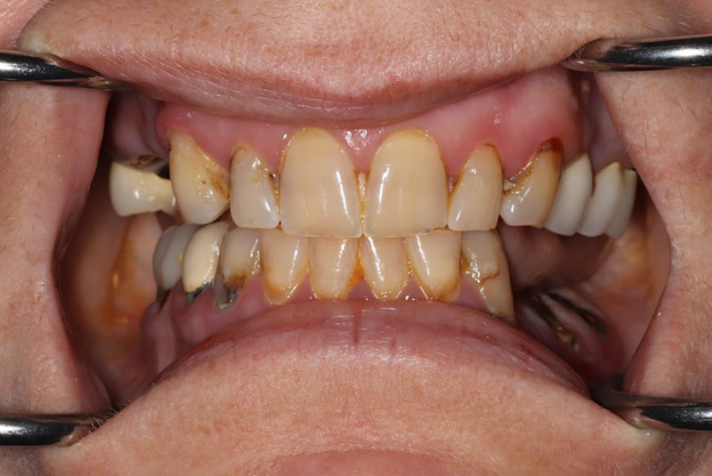 Smile before dental implant treatment