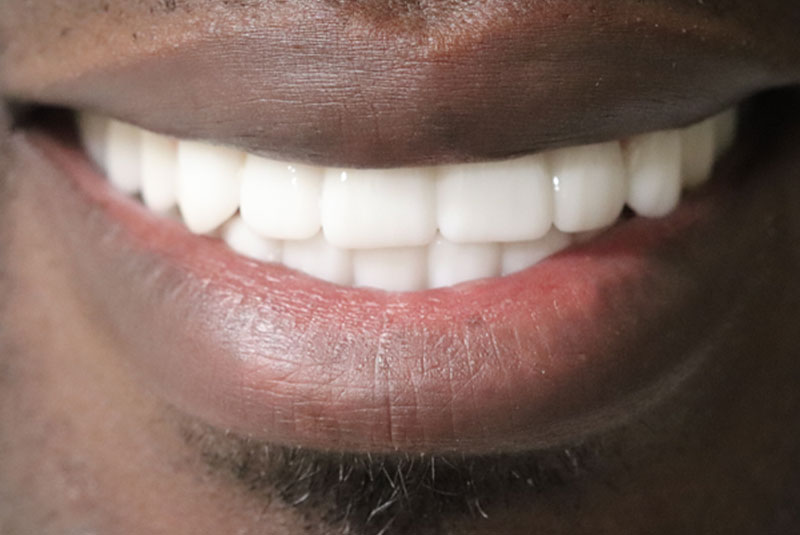 Smile after dental implant treatment