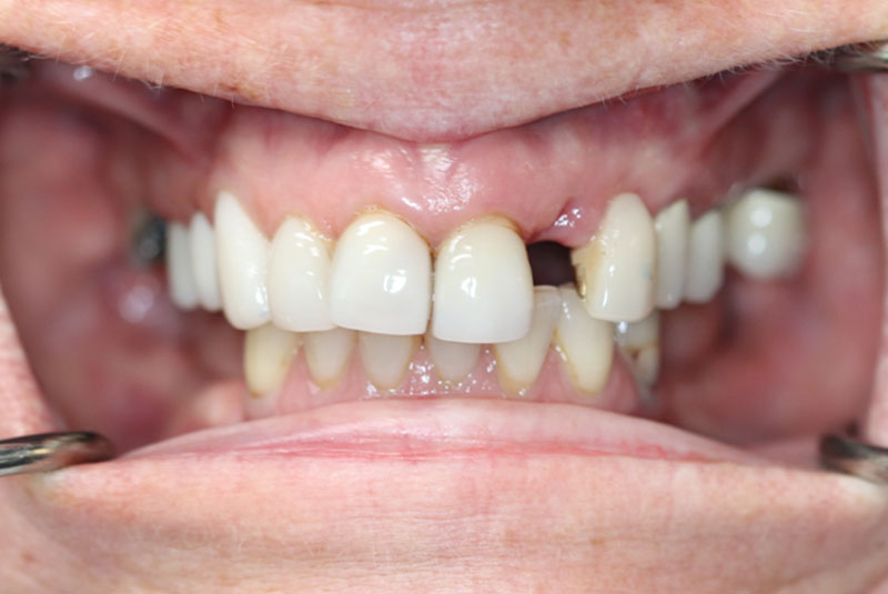 Smile before dental implant treatment