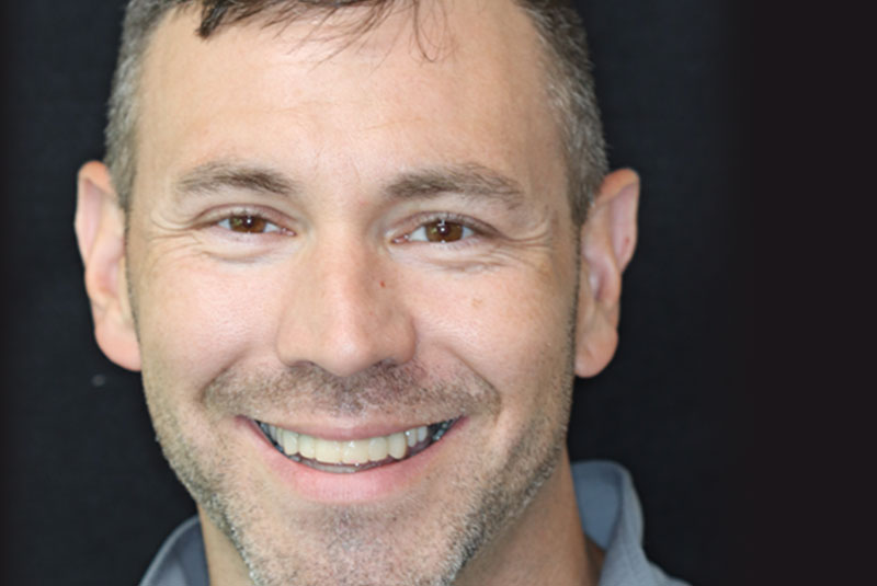 Smile before dental implant treatment