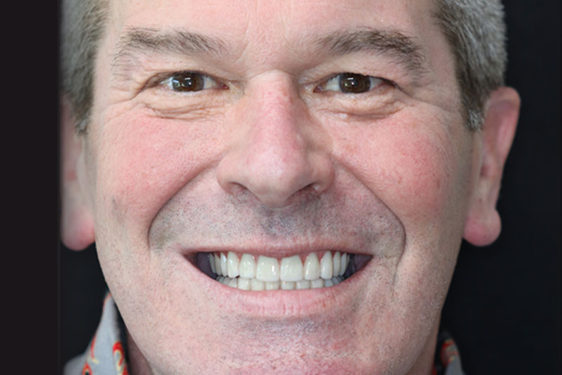 Smile after dental implant treatment
