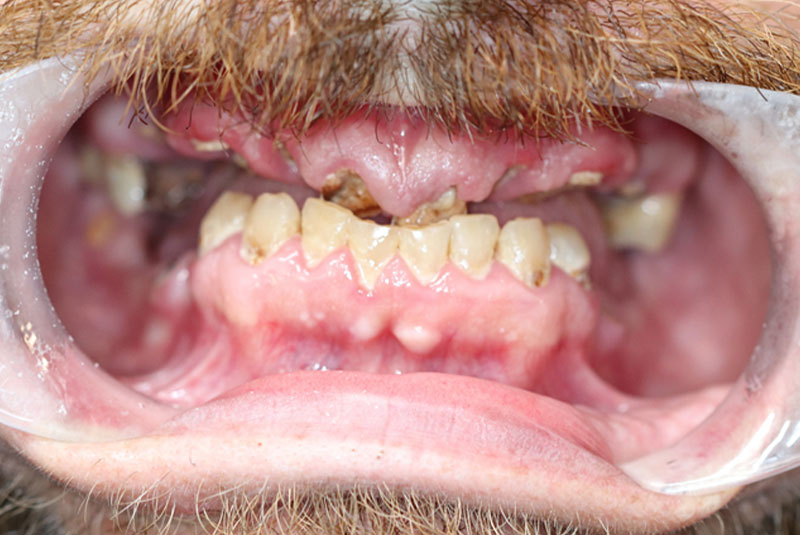 Smile before dental implant treatment