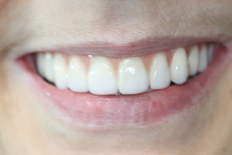 Smile after dental implant treatment
