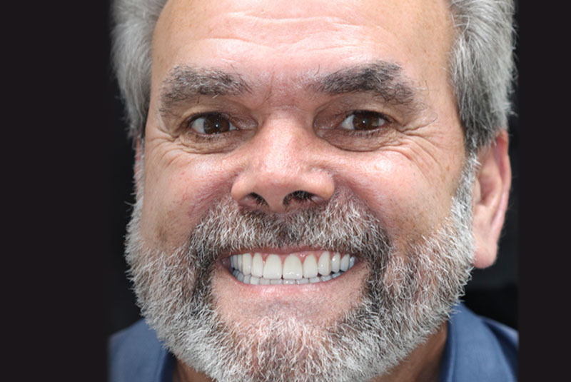 Smile after dental implant treatment