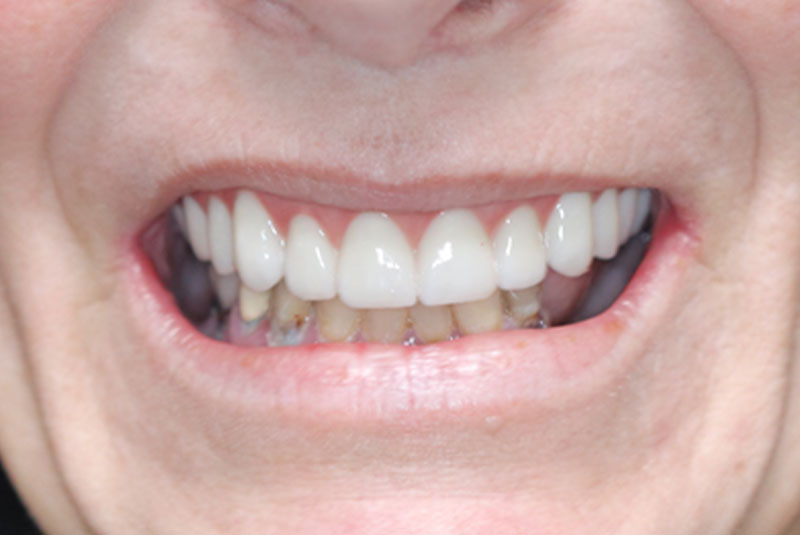 Smile after dental implant treatment