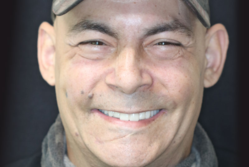 Smile after dental implant treatment