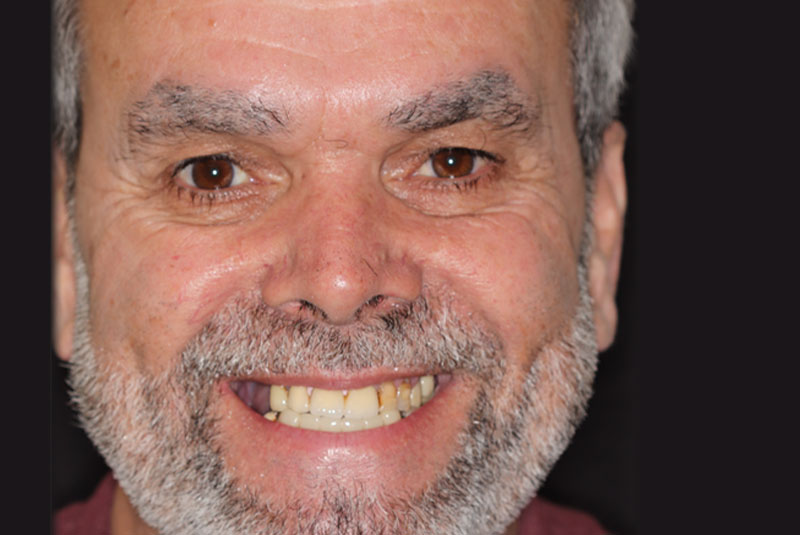 Smile before dental implant treatment