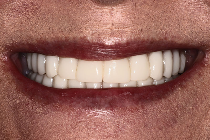 Smile after dental implant treatment