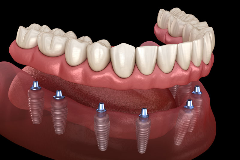 Full Mouth Dental Implants