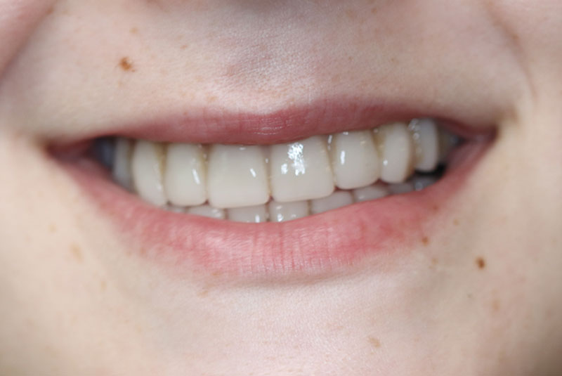 Smile after dental implant treatment