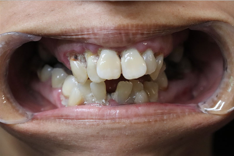 Smile before dental implant treatment