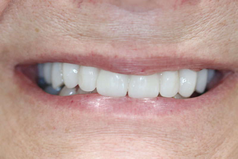 Smile after dental implant treatment