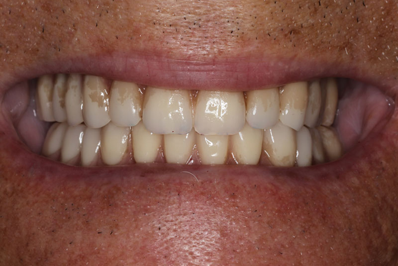 Smile after dental implant treatment