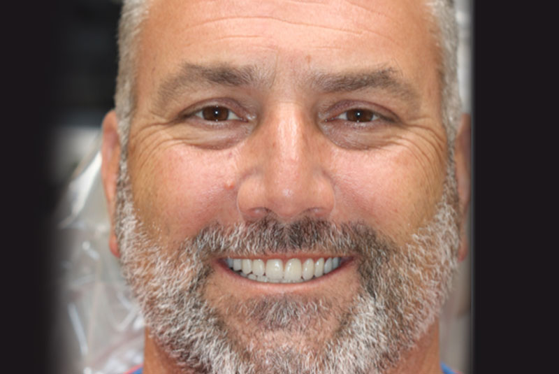 Smile after dental implant treatment
