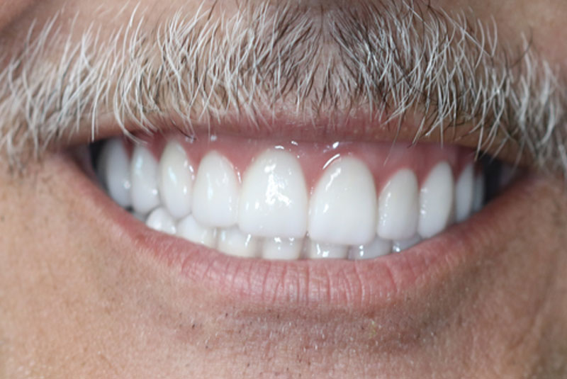Smile after dental implant treatment