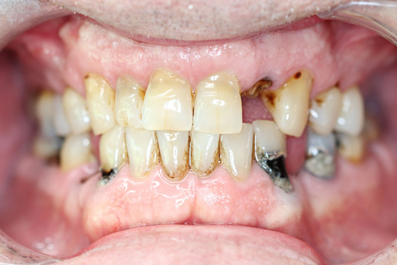 Smile before dental implant treatment