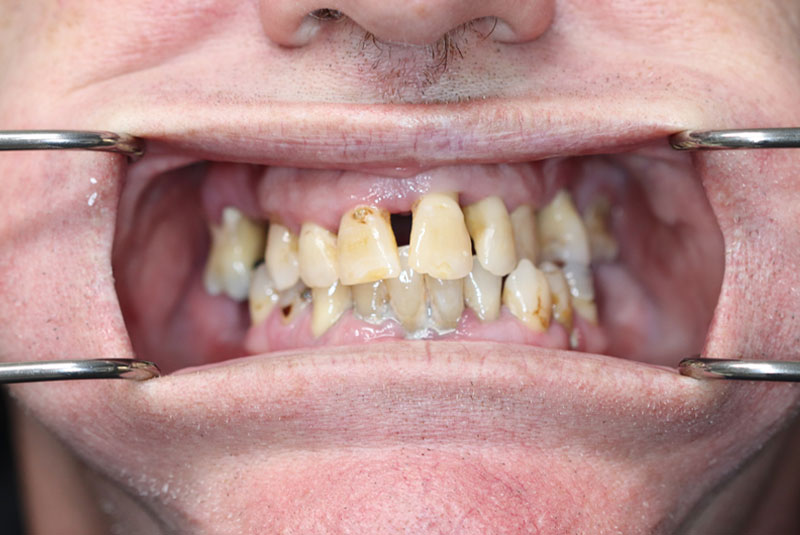 Smile before dental implant treatment