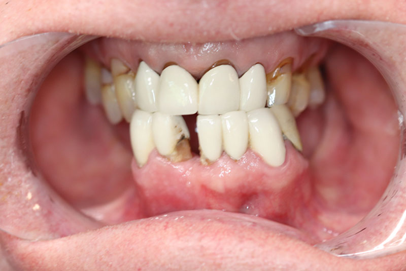 Smile before dental implant treatment