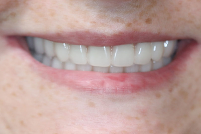 Smile after dental implant treatment
