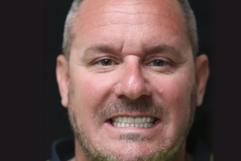 Smile after dental implant treatment