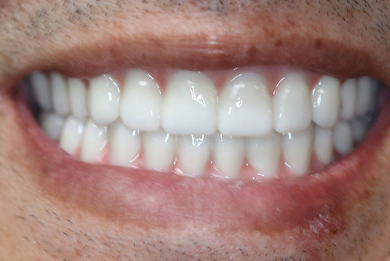 Smile after dental implant treatment